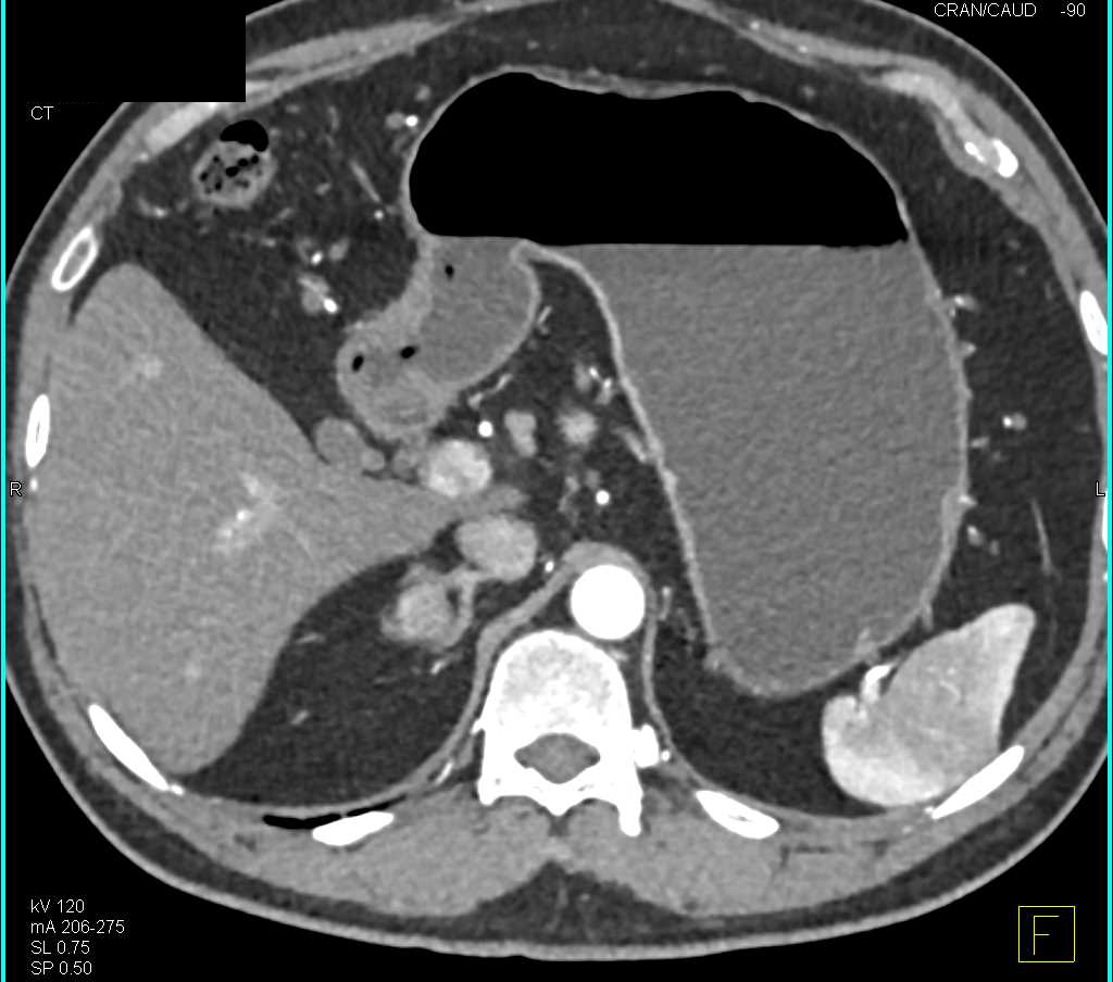 Pheochromocytoma of the Right Adrenal Gland - CTisus CT Scan