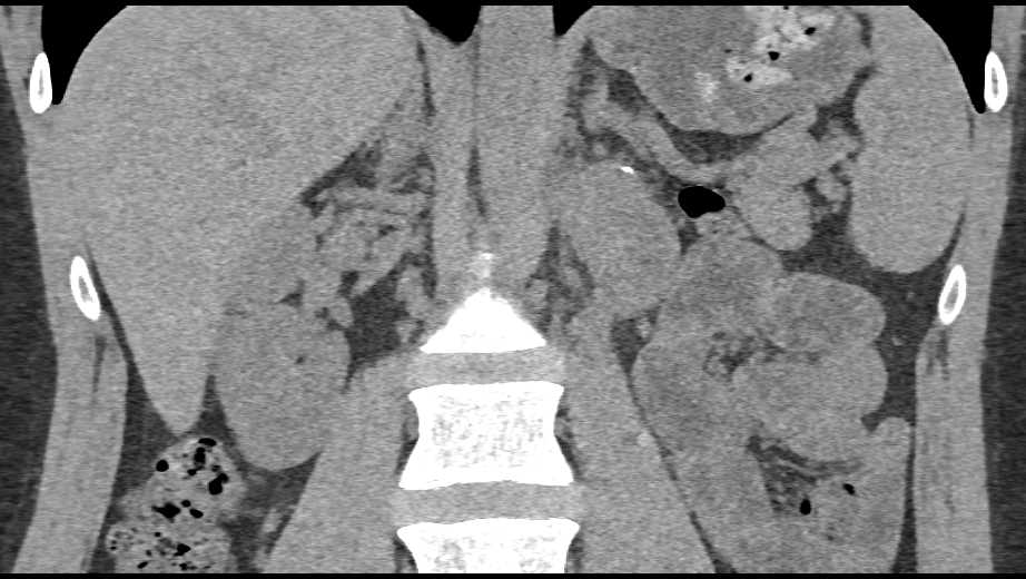 Recurrent Germ Cell Tumor Near Renal Bed - CTisus CT Scan