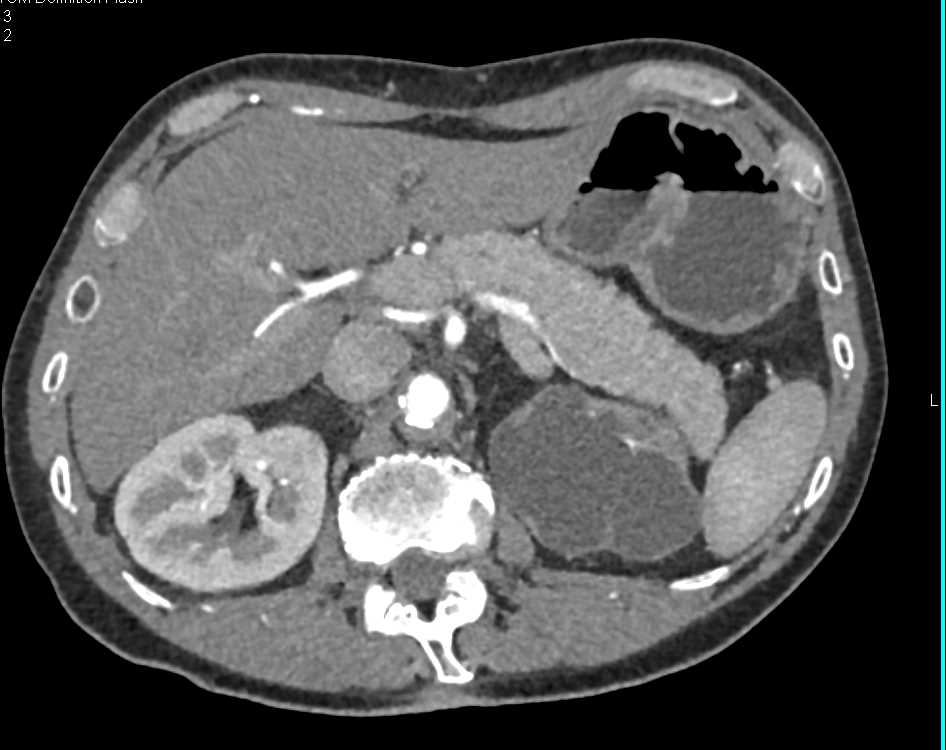 Left Hydronephrosis with Distal Obstuction - CTisus CT Scan