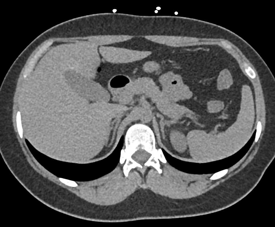 Duplicated Collecting System with Nice 3D Definition of the Ureters - CTisus CT Scan