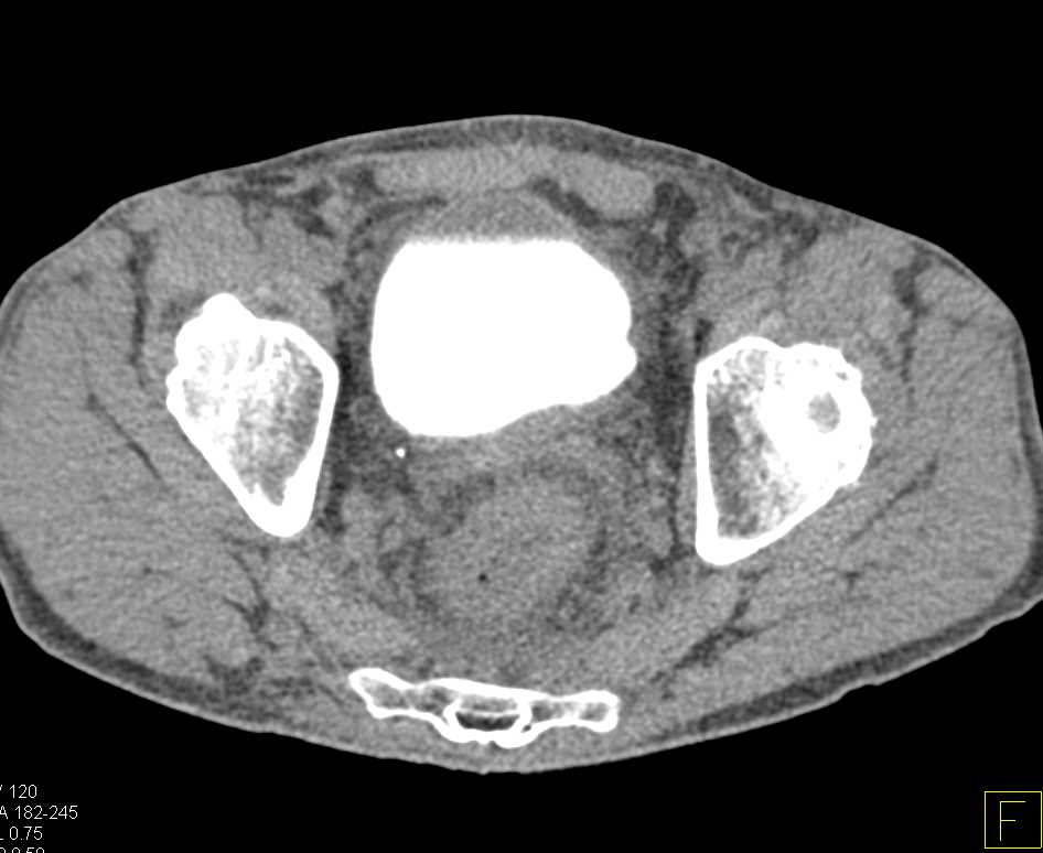 Bladder Cancer on CT Cystogram - CTisus CT Scan