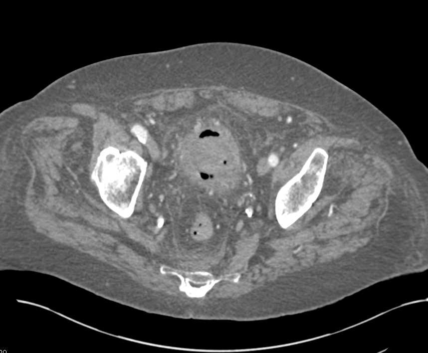 Infiltrating Transitional Cell Cancer (TCC) of the Bladder - CTisus CT Scan