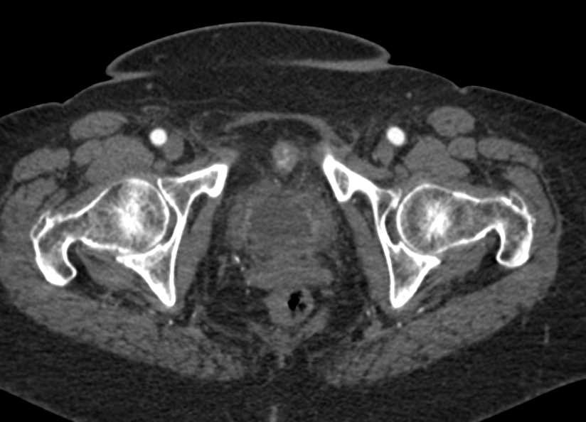 Urachal Carcinoma - CTisus CT Scan