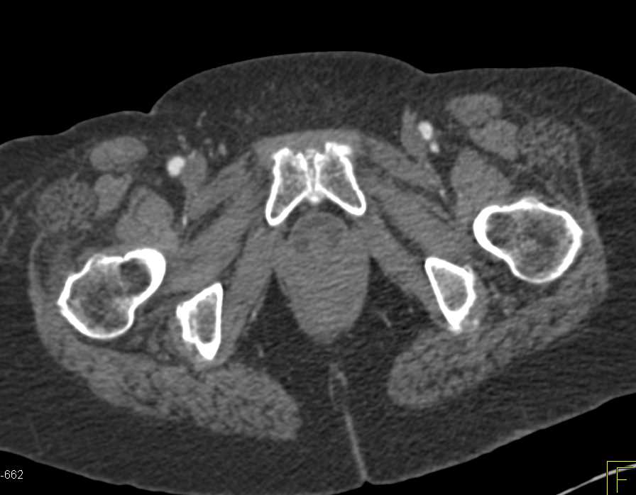 Mass in Base of Bladder Pushing into the Urethra - CTisus CT Scan