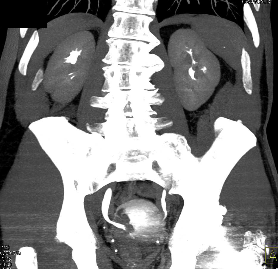 Incidental Bladder Cancer is Subtle on Arterial Phase Images - CTisus CT Scan