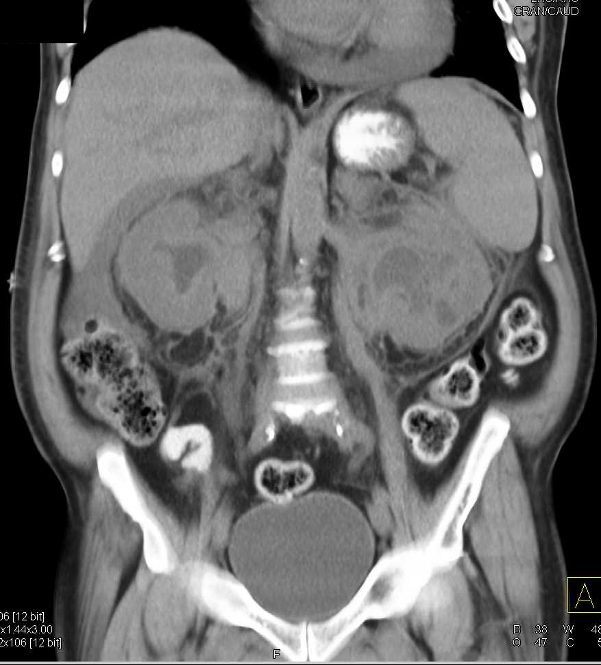 Perirenal Infiltration in Erdheim-Chester Disease - CTisus CT Scan