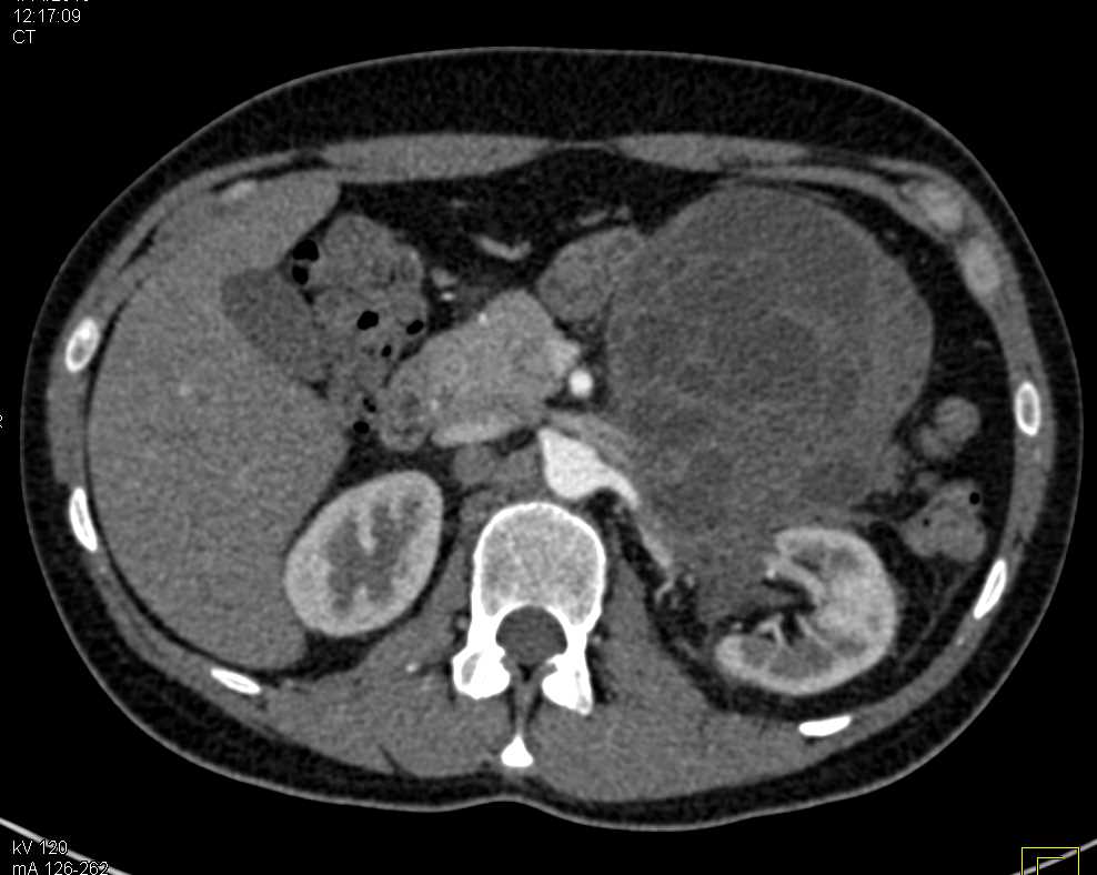 Germ Cell Tumor Simulates a Pancreatic Mass - CTisus CT Scan