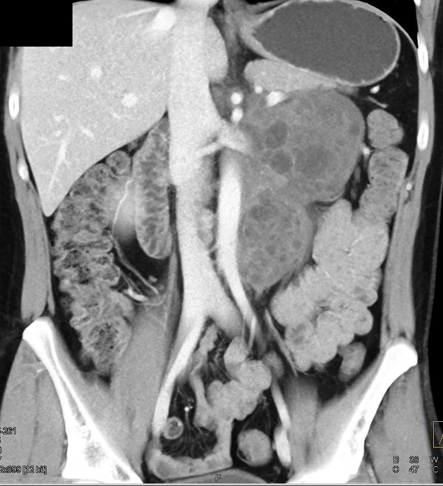 Germ Cell Tumor Simulates a Pancreatic Mass - CTisus CT Scan