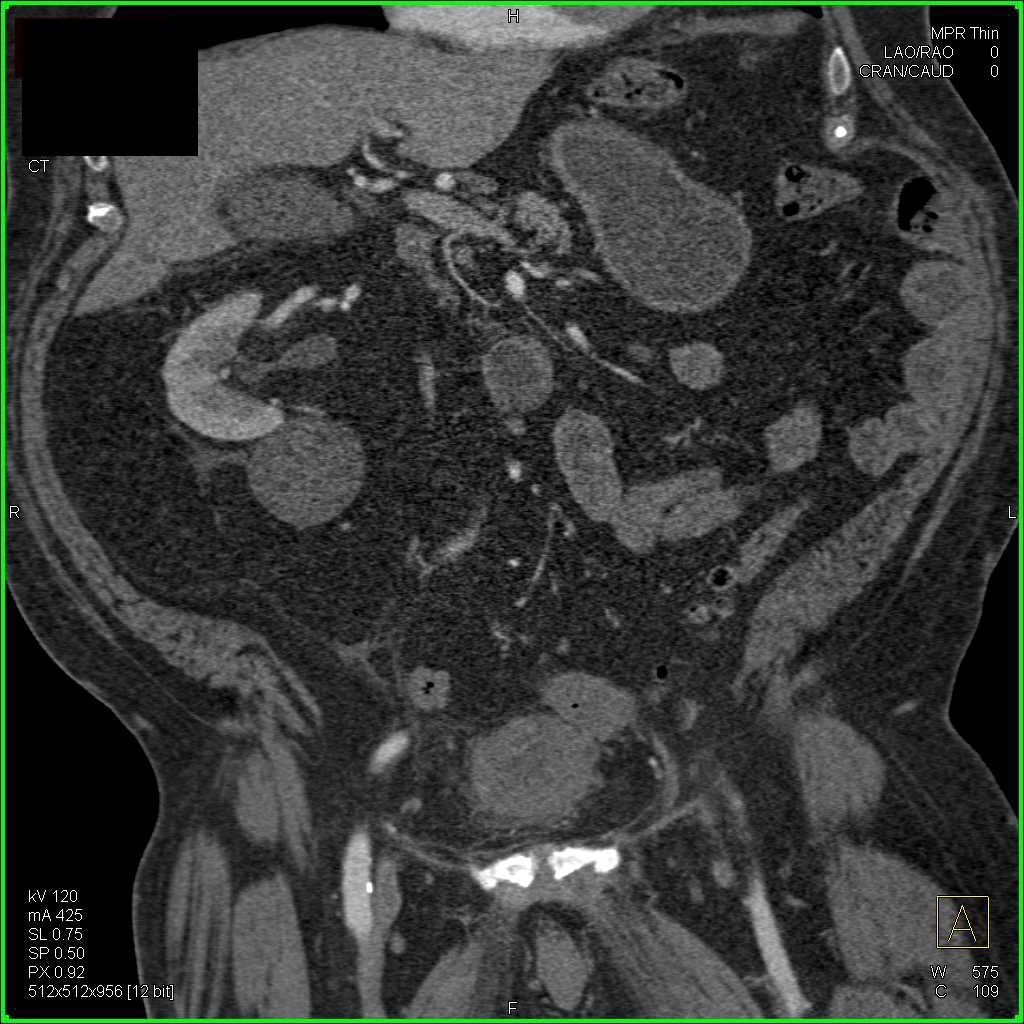 Transitional Cell Cancer (TCC) Bladder in Patient with Nephrectomy for TCC Kidney - CTisus CT Scan