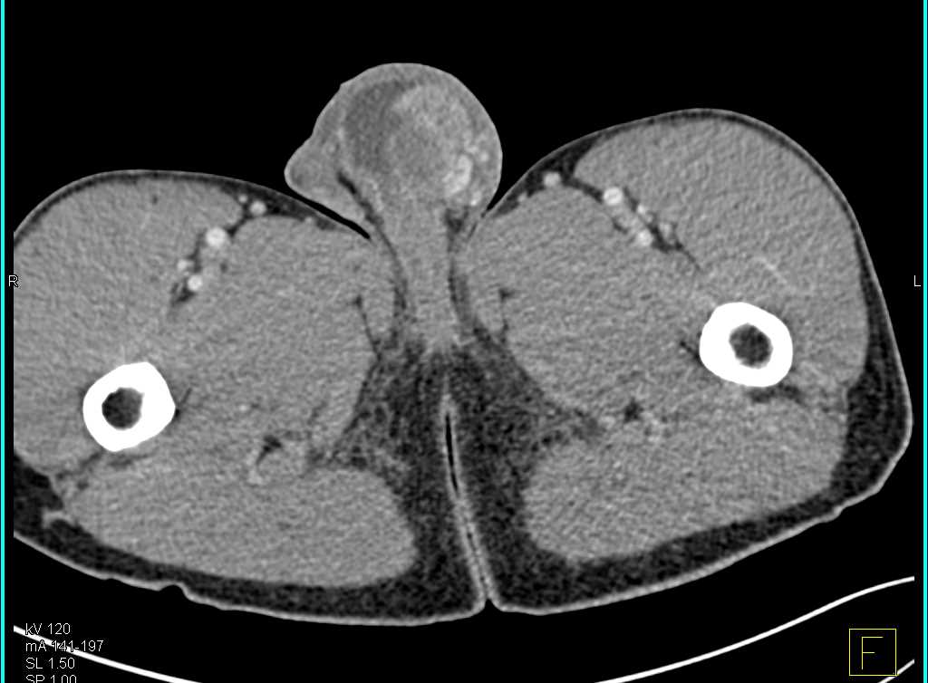 Testicular Trauma - CTisus CT Scan