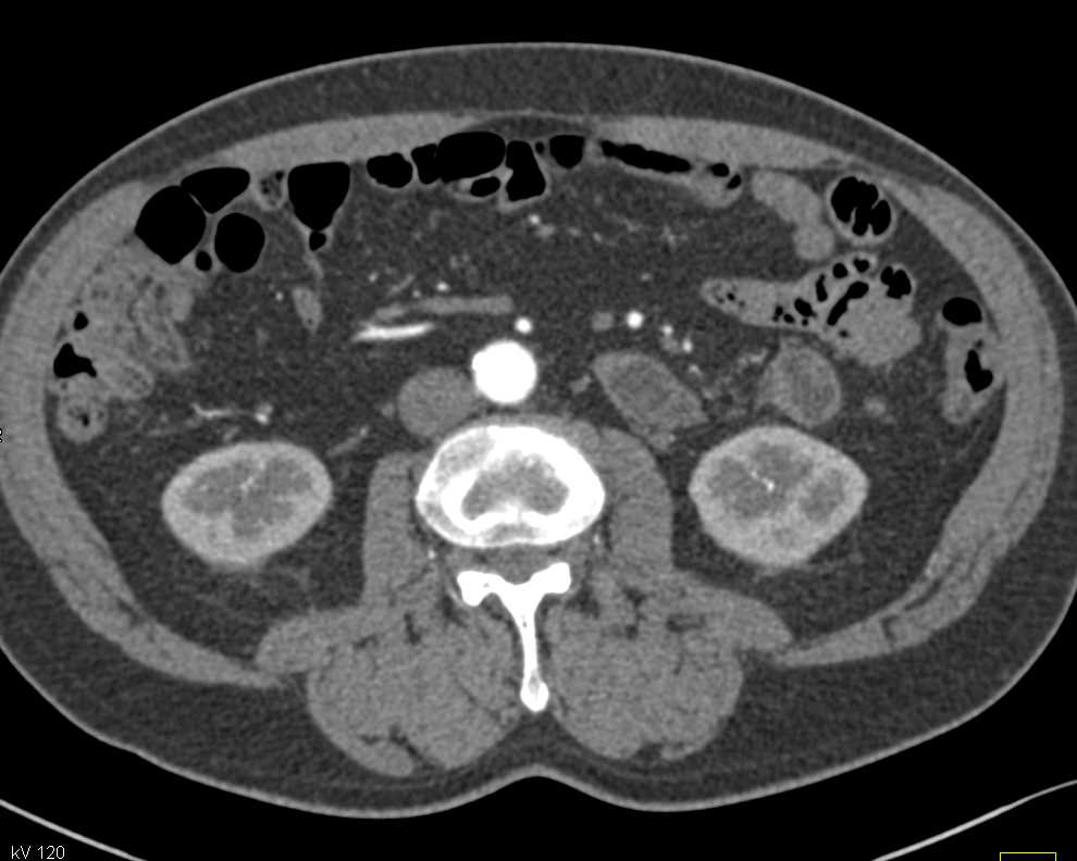 Calcifications in a Calyceal Diverticulum - CTisus CT Scan