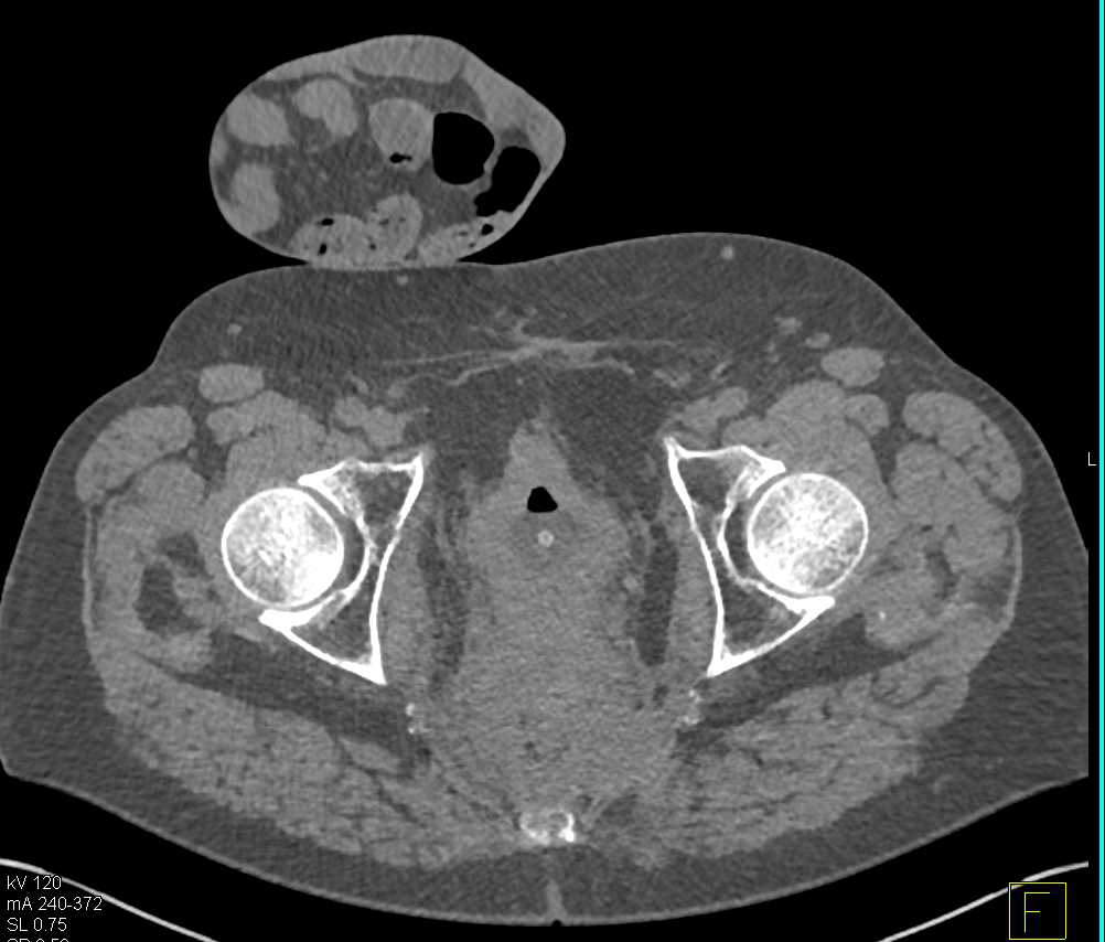 Fistulae from Bladder to Rectum on CT Cystogram - CTisus CT Scan