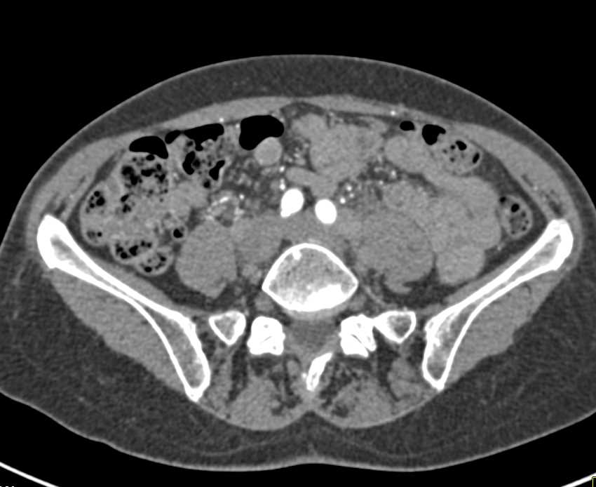 Bladder Cancer in Anterior Superior Bladder Wall - CTisus CT Scan