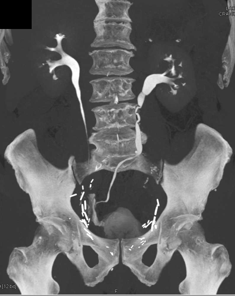 CT Urography with Neobladder - CTisus CT Scan