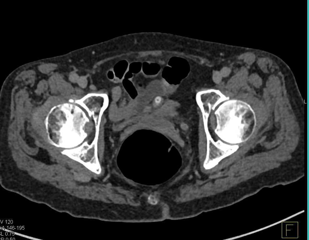 Carcinoma Distal Left Ureter with Left Hydropnephrosis and Inflammation - CTisus CT Scan