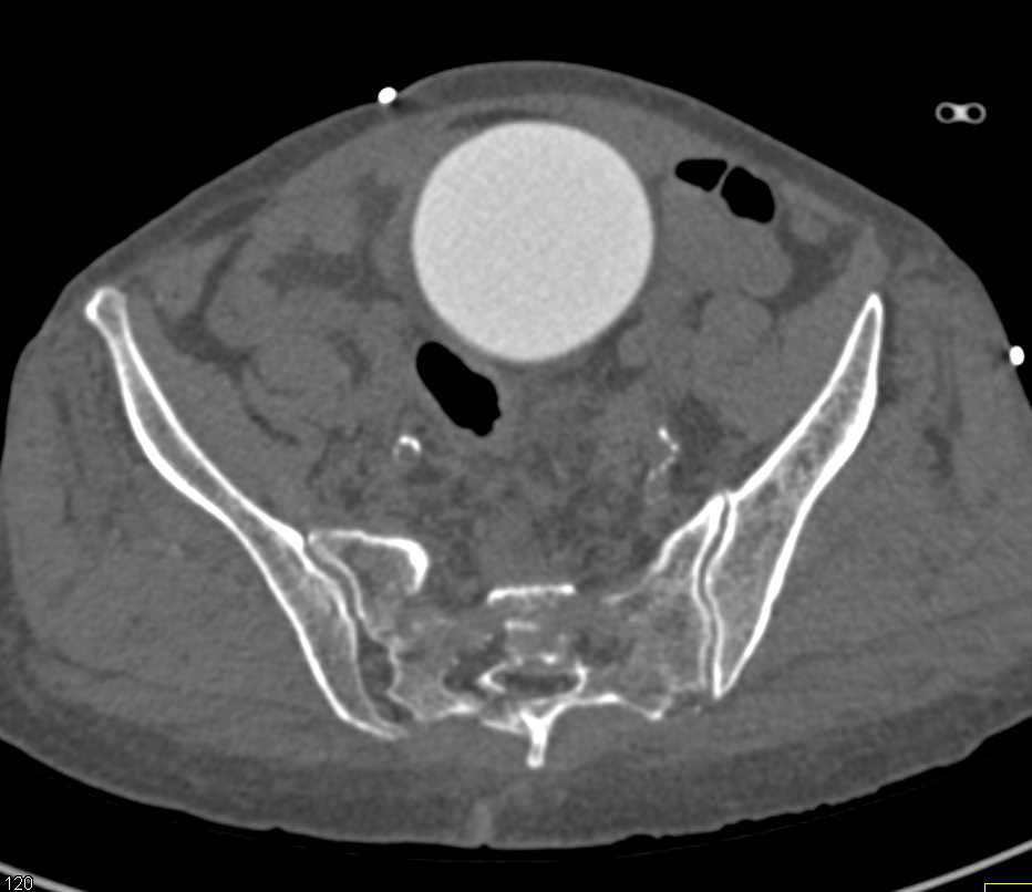 Normal CT Cystogram - CTisus CT Scan