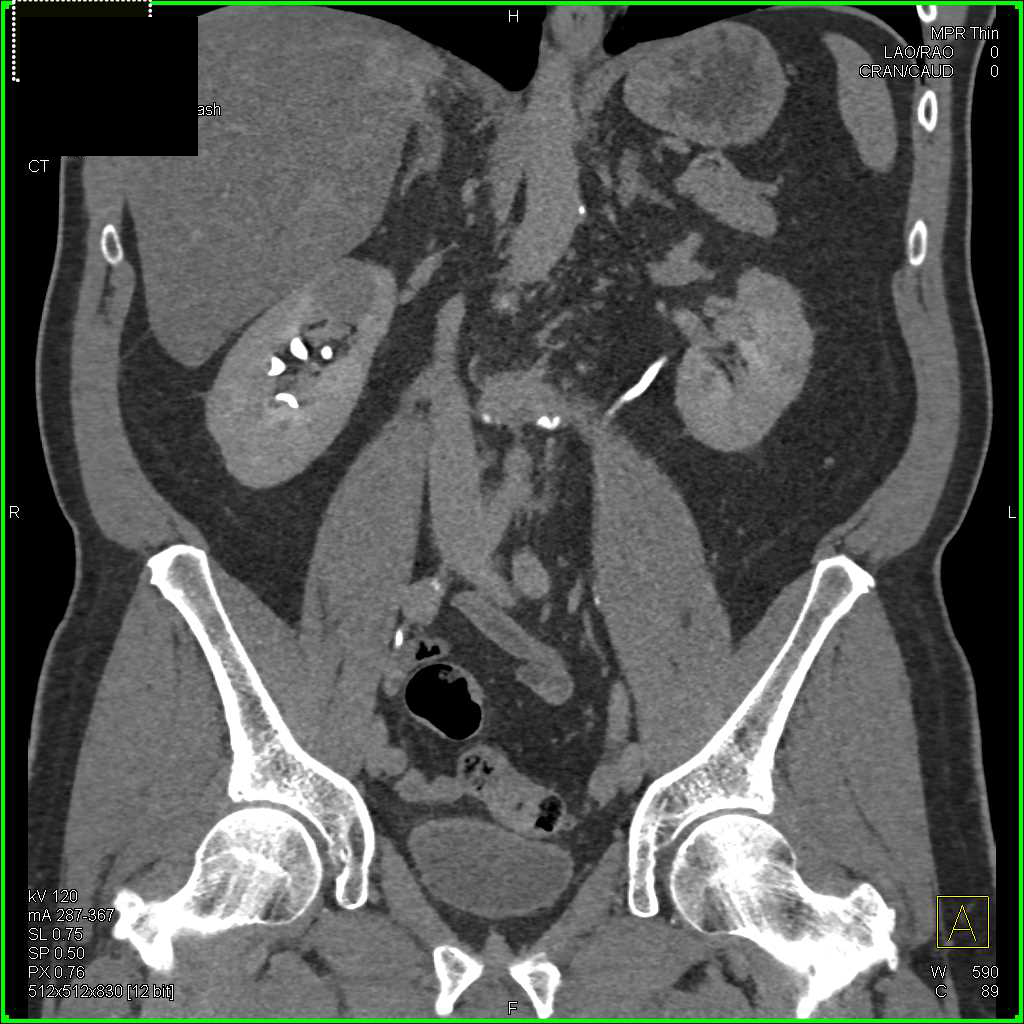 Papillary Renal Cell Carcinoma Right Kidney - CTisus CT Scan