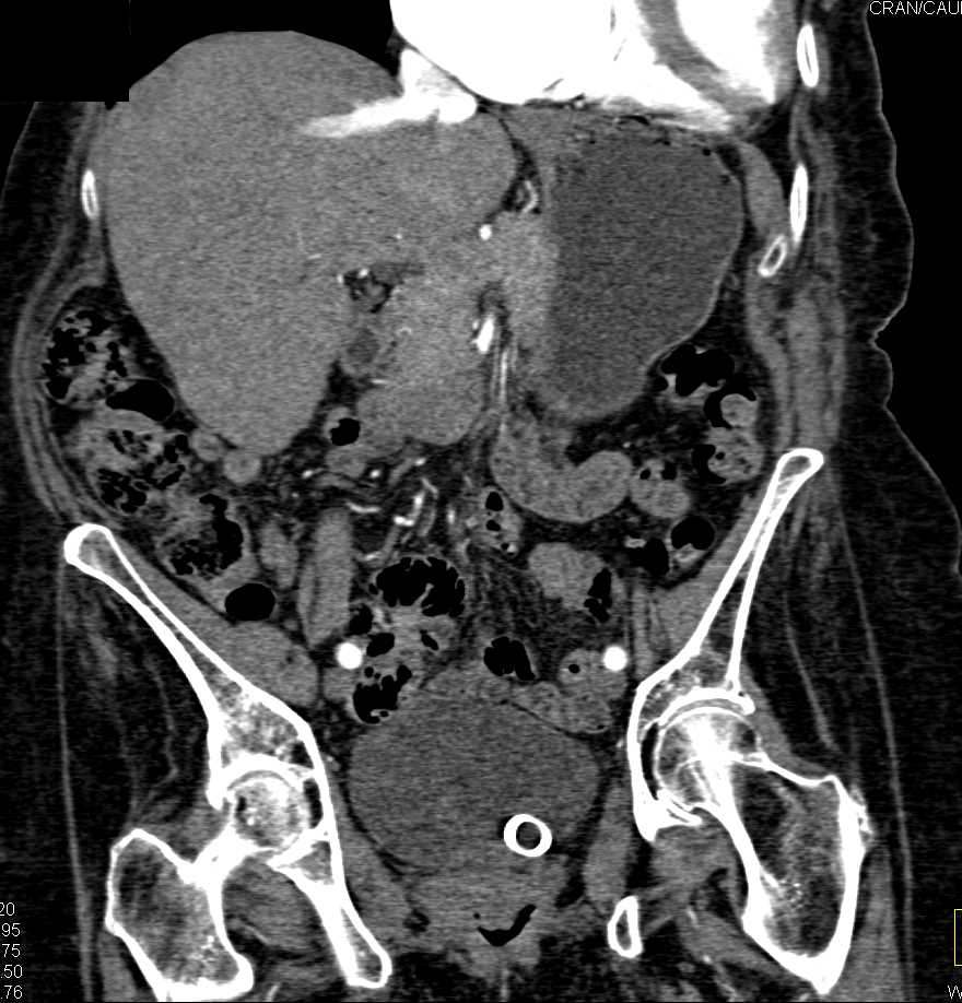 Transitional Cell Carcinoma Left Renal Pelvis - CTisus CT Scan