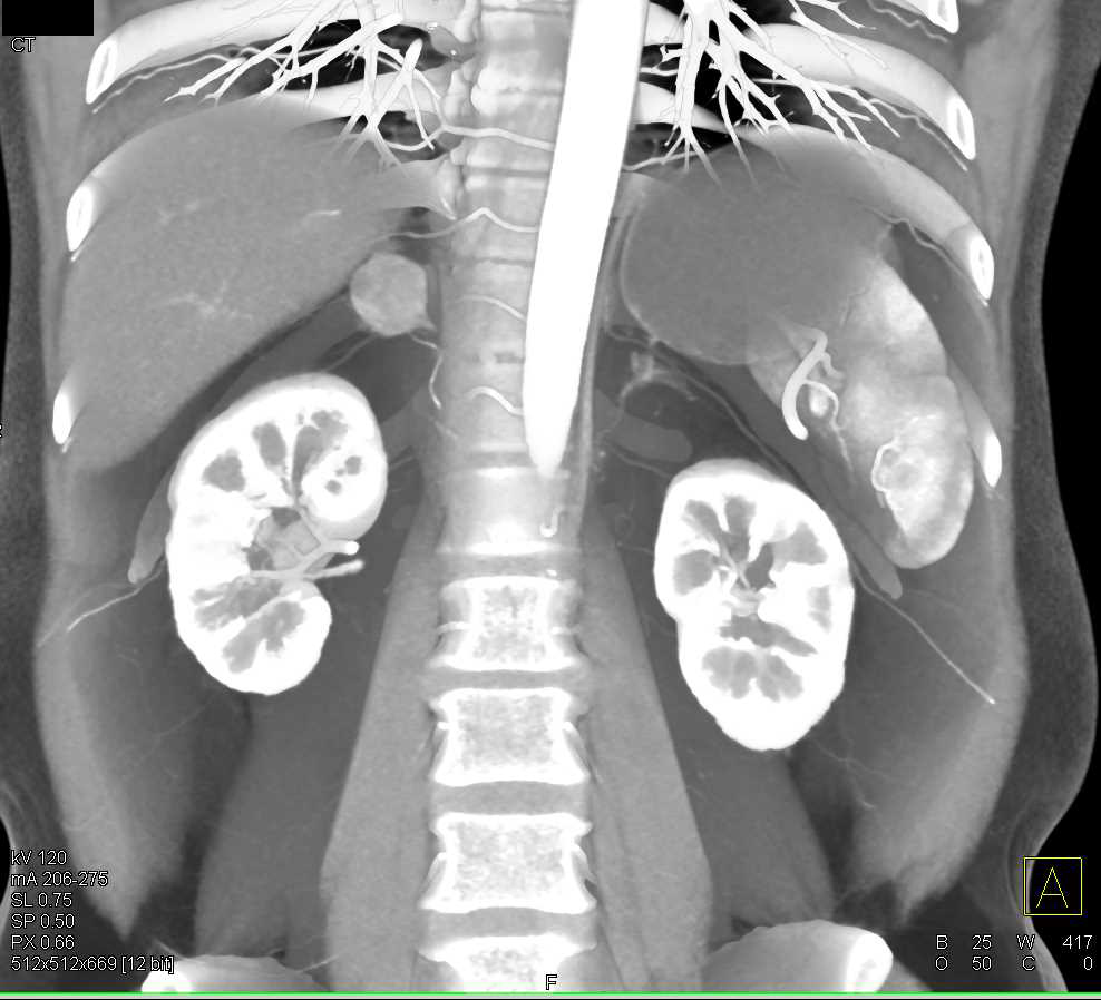 Incidental Pheochromocytoma Right Adrenal Gland - CTisus CT Scan