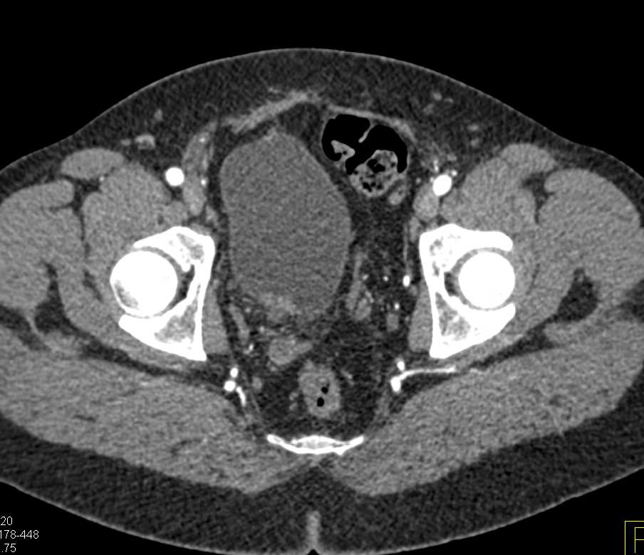 Bladder Cancer Near Right Ureterovesical Junction (UVJ) - CTisus CT Scan