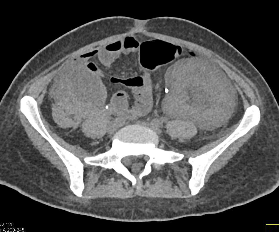 CT Cystogram with Leak Following Renal Transplant - CTisus CT Scan