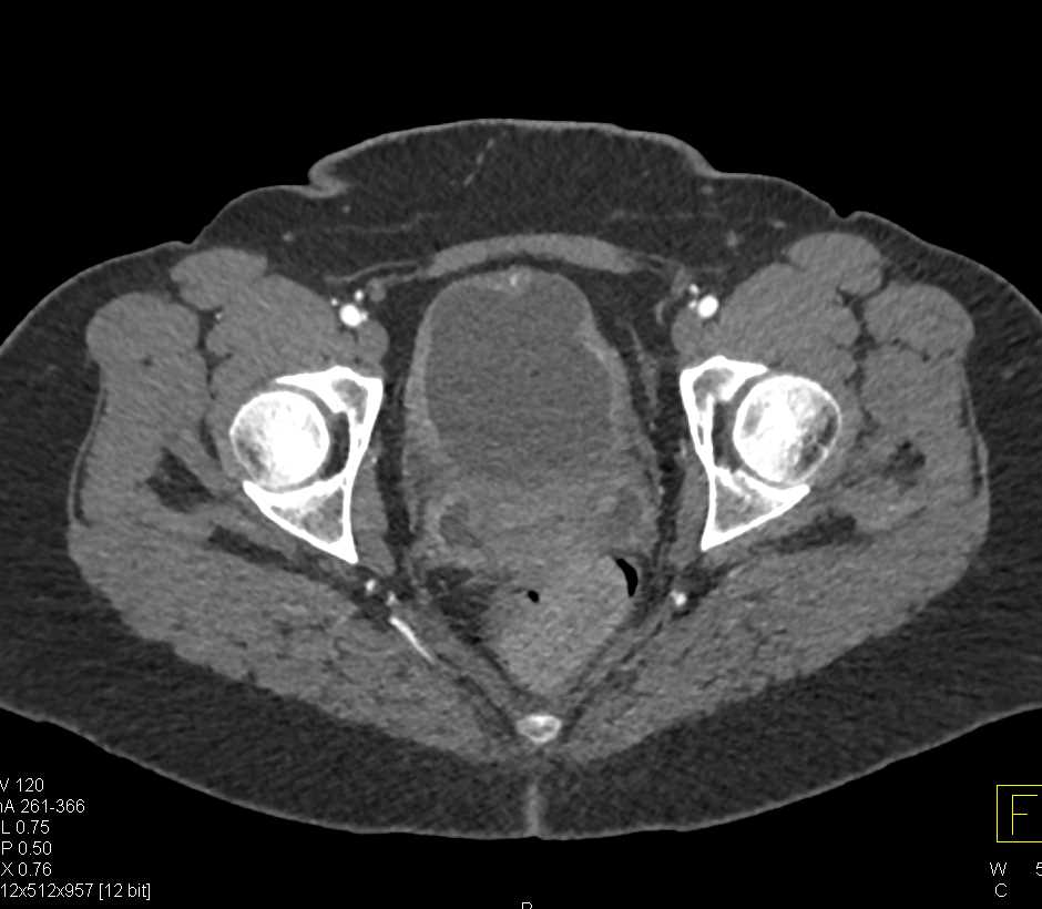 Bladder Cancer - CTisus CT Scan