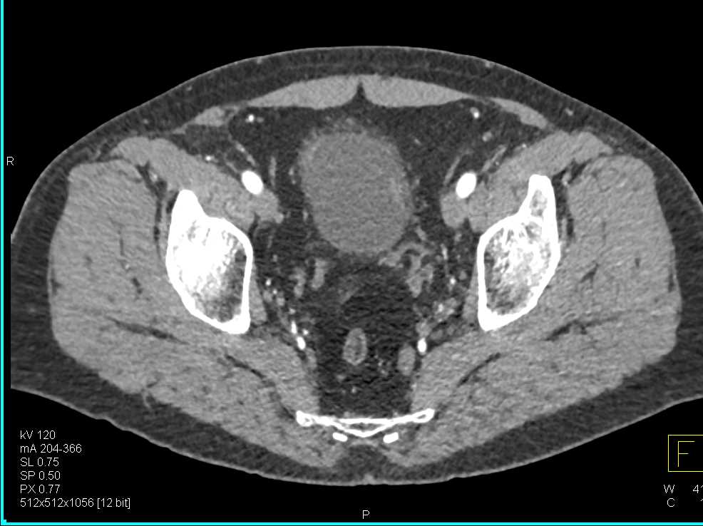 Subtle Bladder Cancer - CTisus CT Scan