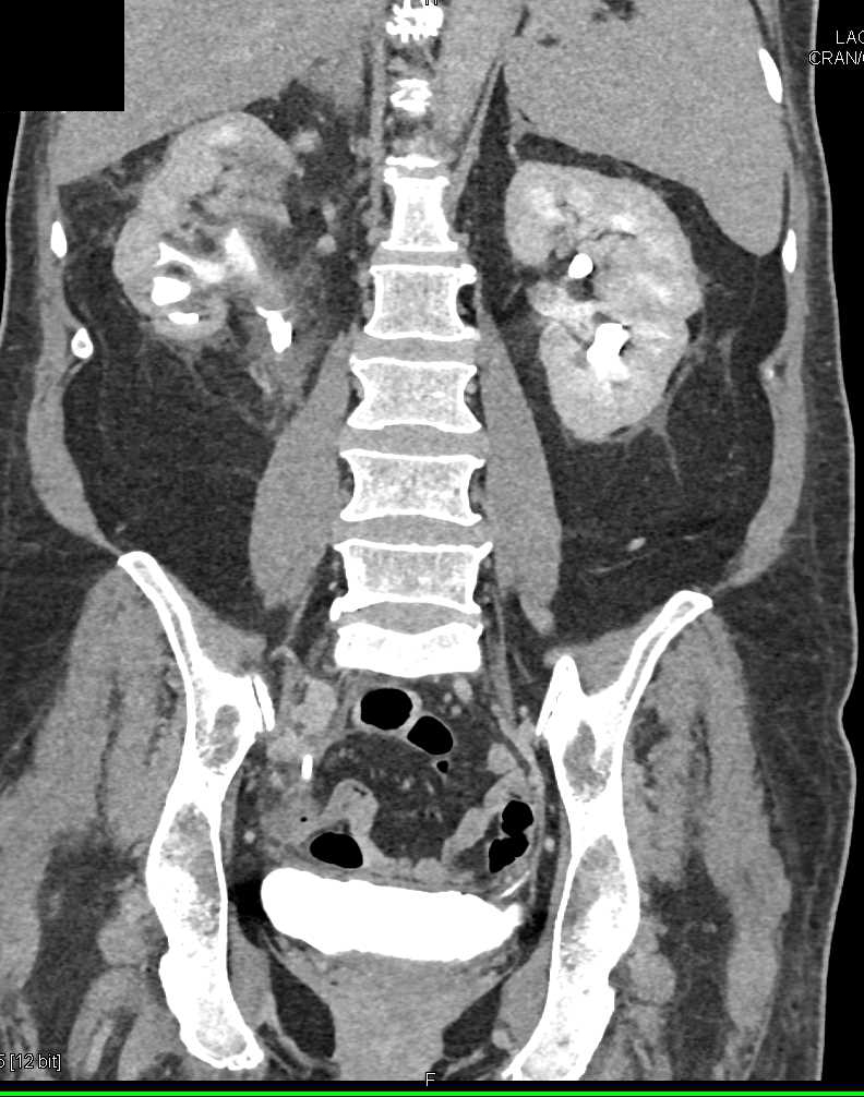 Transitional Cell Carcinoma of the Right Renal Pelvis - CTisus CT Scan