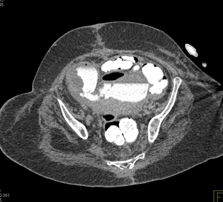 Fistulae Between Bladder and Colon - CTisus CT Scan