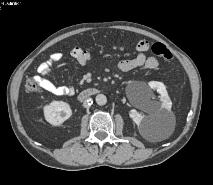 Bladder Cancer as the Cause for Hematuria - CTisus CT Scan