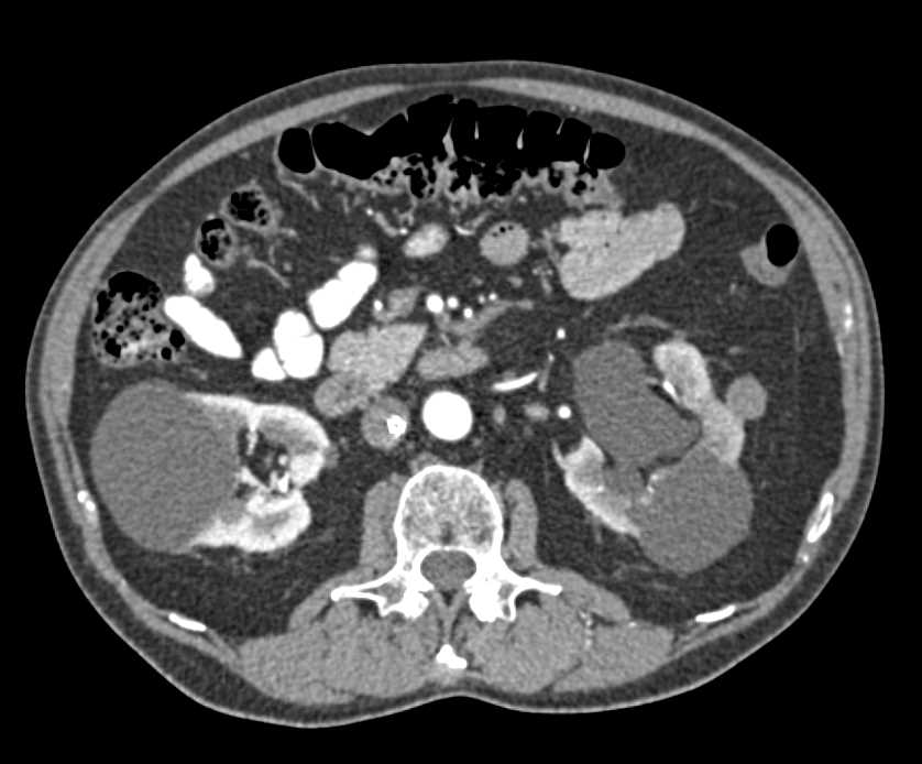 Bladder Cancer as the Cause for Hematuria - CTisus CT Scan