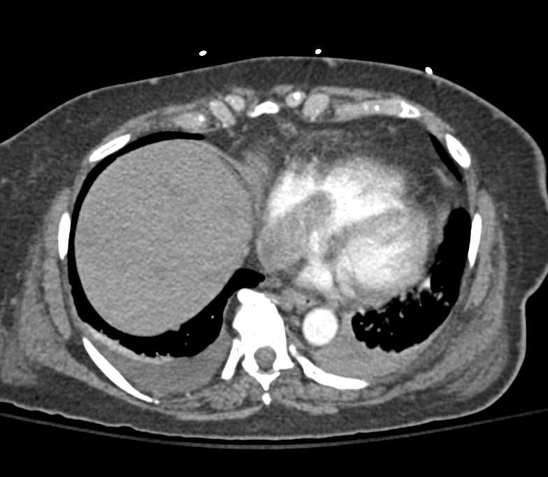 Right Rectus Hematoma and Left Retroperitoneal Hematoma in a Renal Cancer Patient - CTisus CT Scan