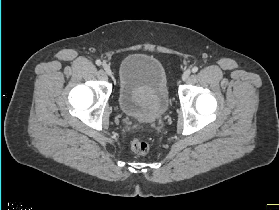 Bladder Cancer Abuts the Stomach - CTisus CT Scan