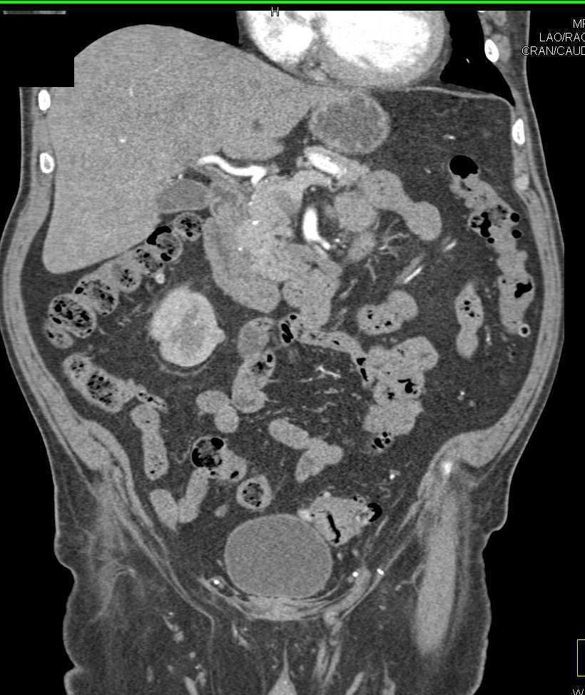 Transitional Cell Carcinoma of the Left Renal Pelvis Looks Like a Renal Cell Carcinoma - CTisus CT Scan