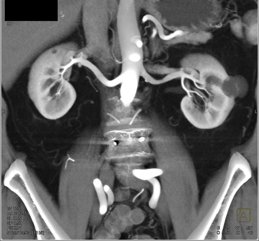 Bosniak 2 Cyst Left Kidney - Genitourinary Case Studies - CTisus CT ...