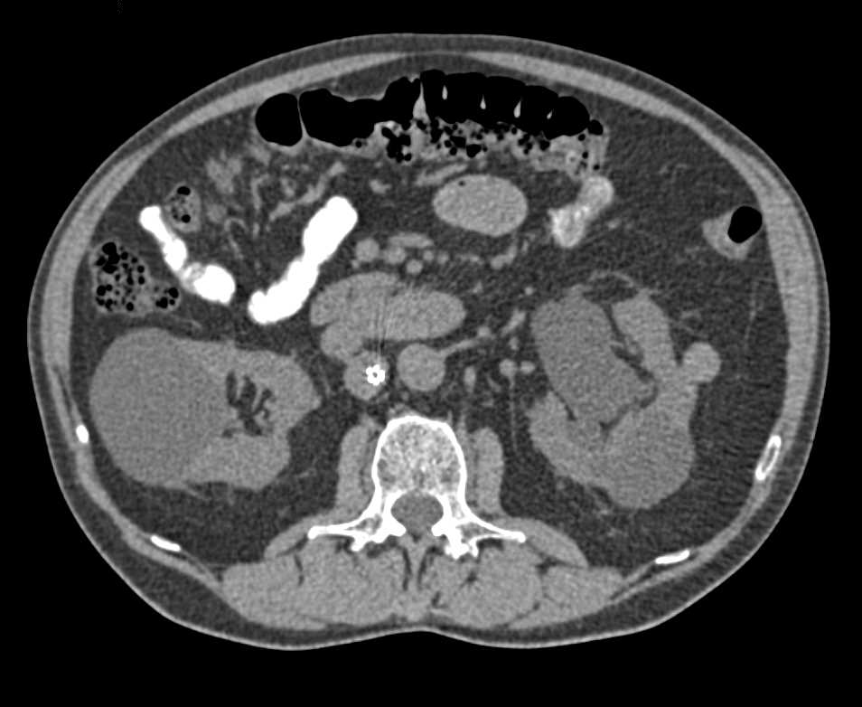 Incidental Bladder Cancer and High Density Renal Cyst - CTisus CT Scan