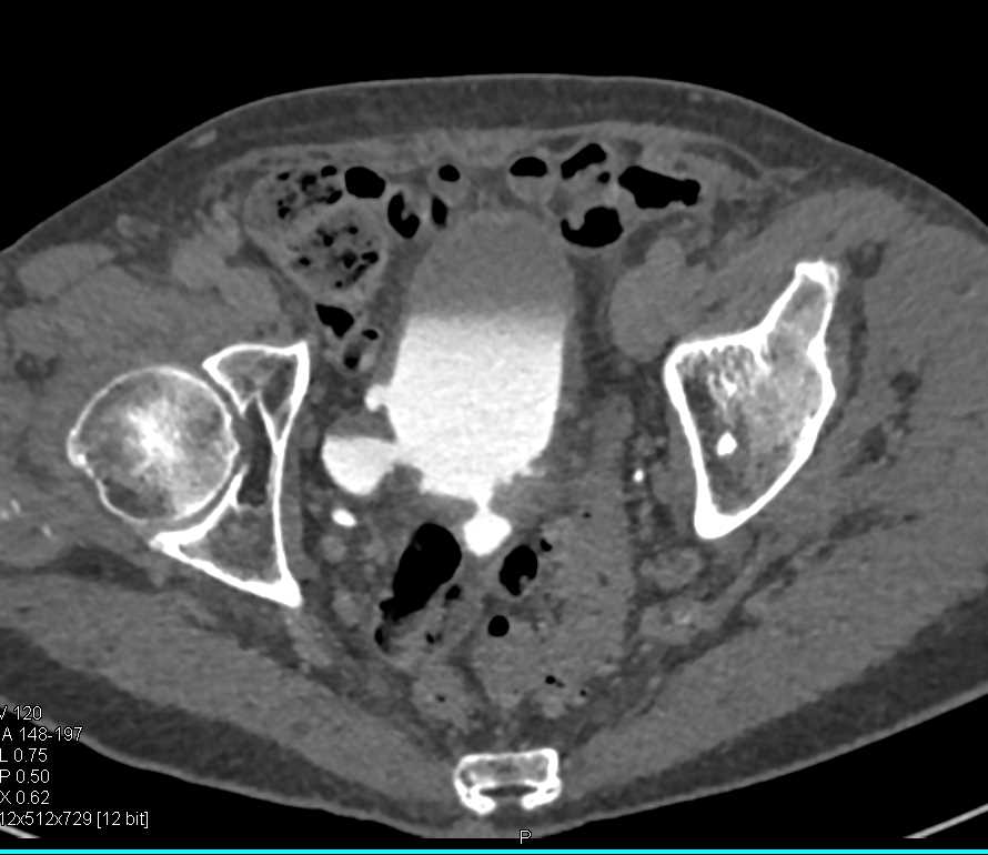 Bladder Diverticulae - CTisus CT Scan