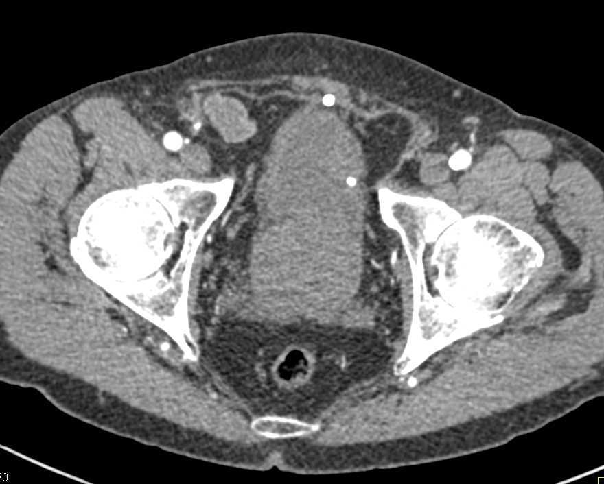 Prostate Cancer Invades Base of Bladder - CTisus CT Scan