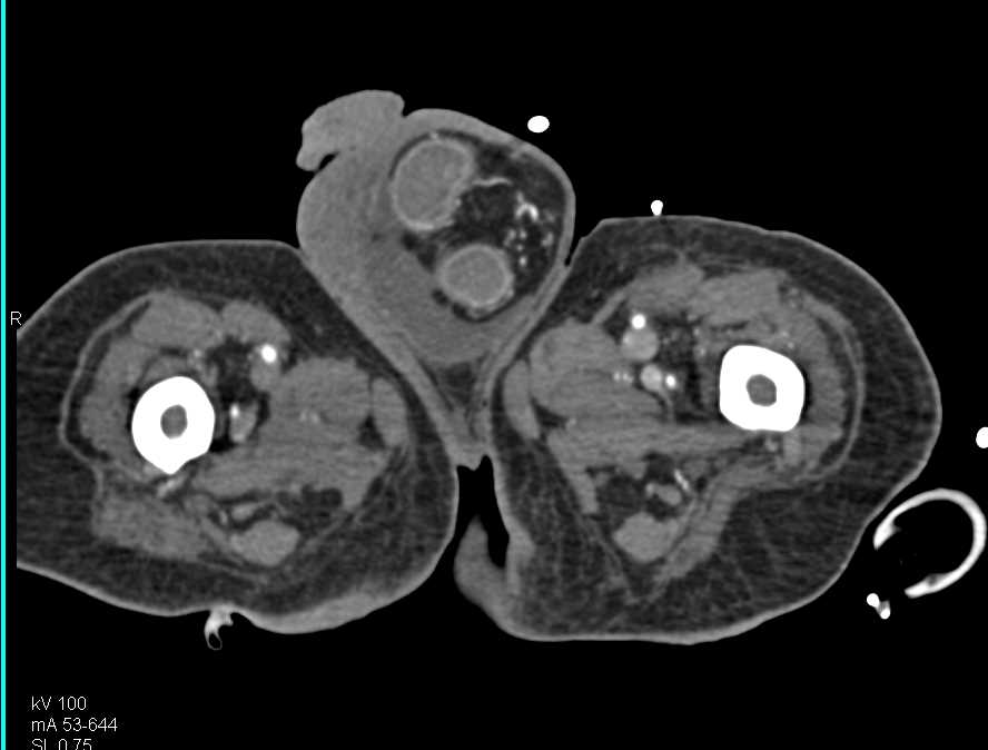 Small Bowel Hernia into the Scrotum - CTisus CT Scan