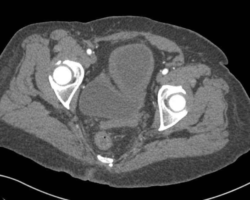 Incidental Bladder Cancer - CTisus CT Scan