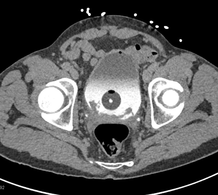 Blood Clots in the Bladder - Genitourinary Case Studies - CTisus CT ...