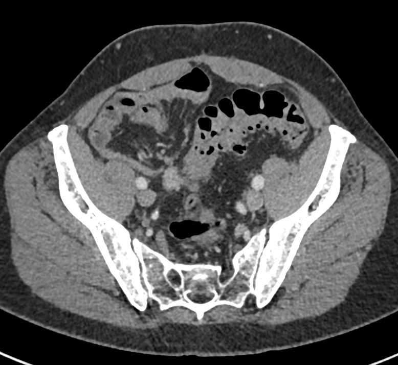 Transitional Cell Carcinoma Right Ureter with Mass Defined and Mass Near Left Ureterovesical Junction (UVJ) - CTisus CT Scan