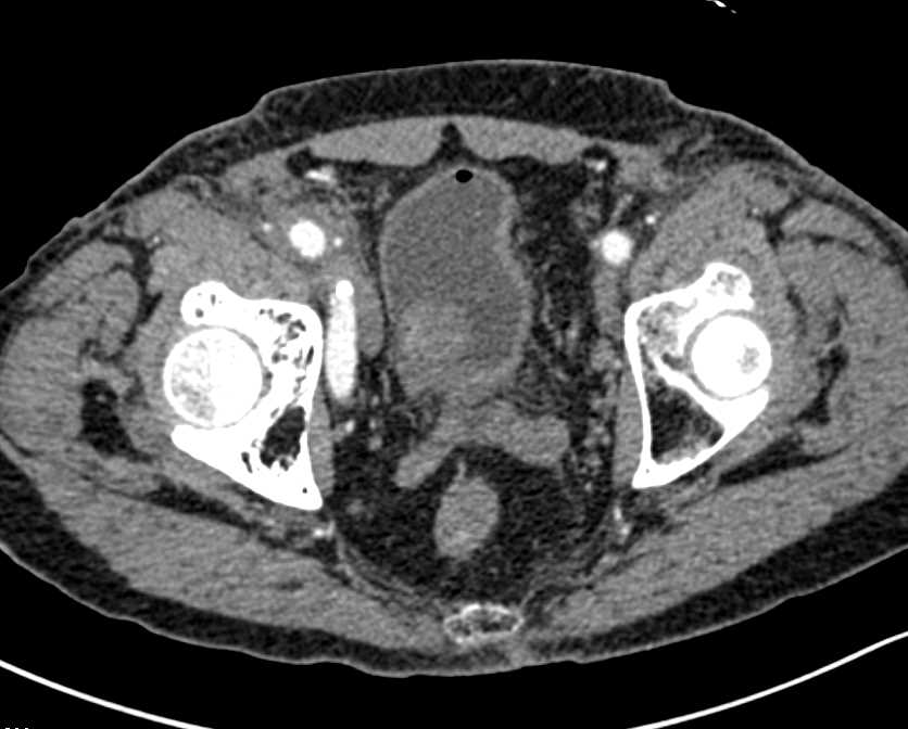 Bladder Cancer - CTisus CT Scan