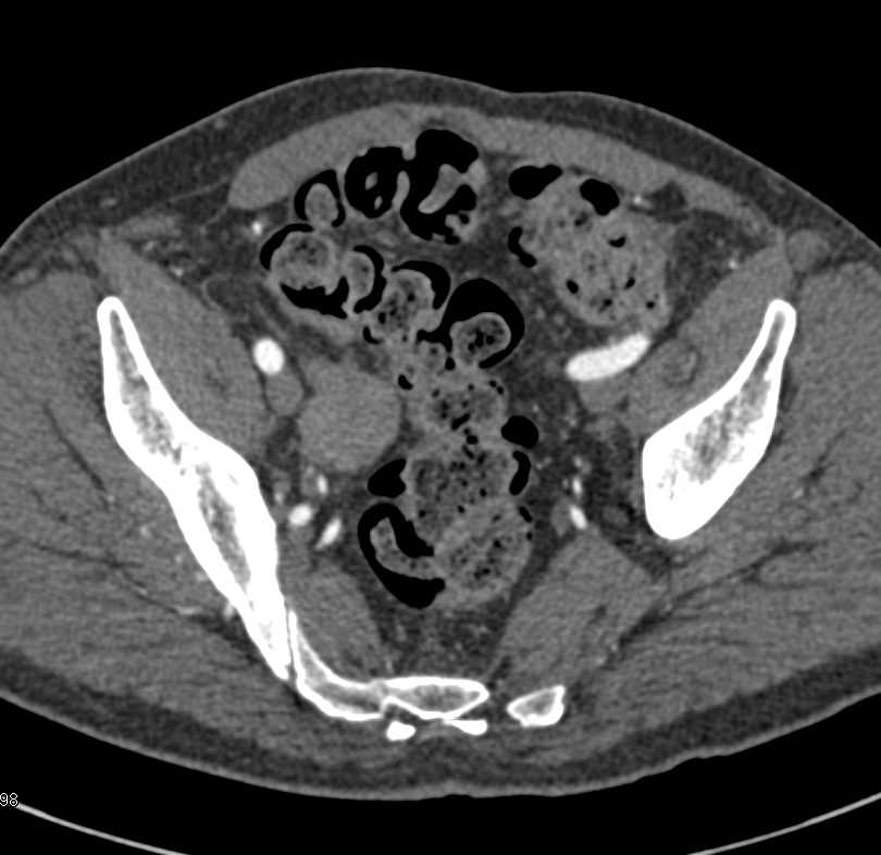 Metastases to the Distal Right Ureter - CTisus CT Scan