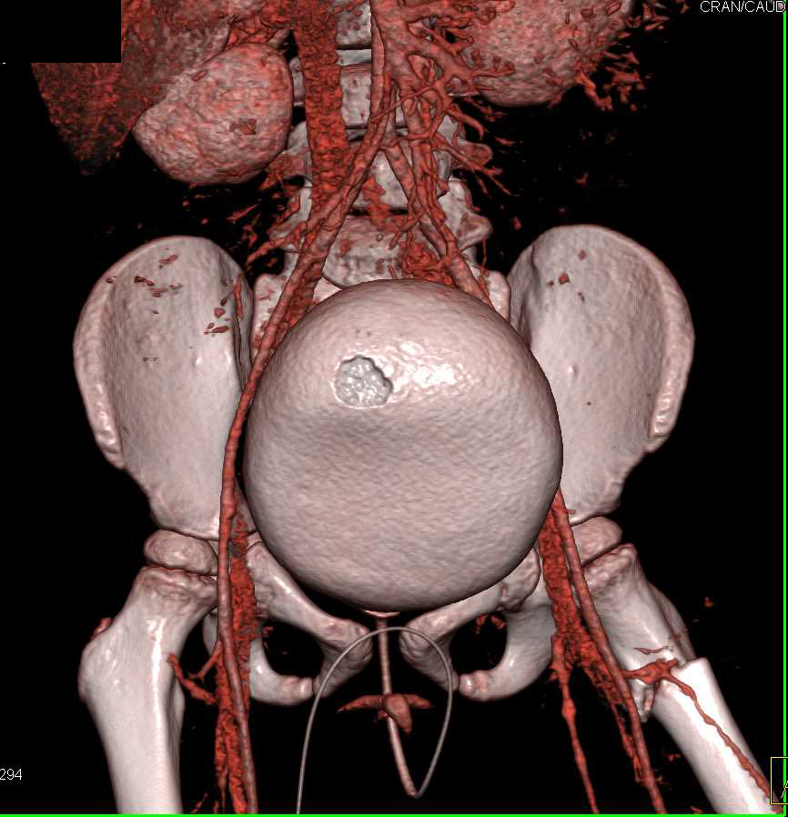 Subtle Sacral Fracture Without Bladder Injury on CT Cystogram - CTisus CT Scan