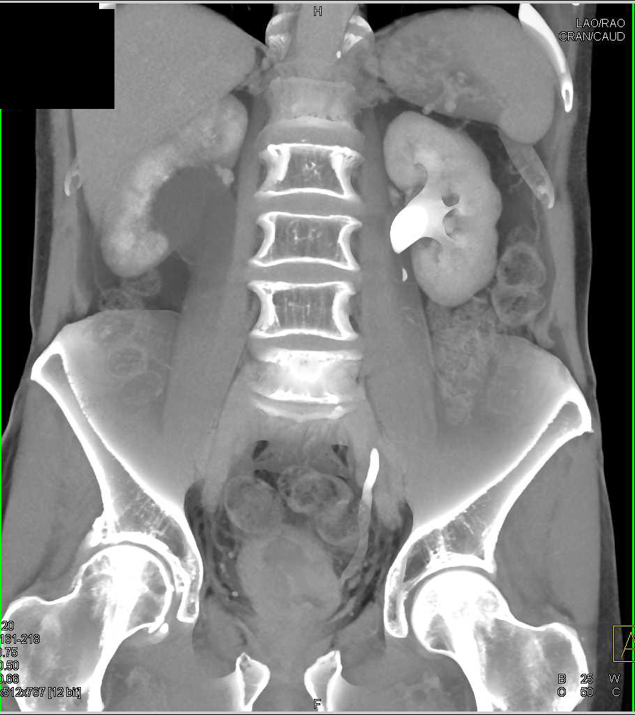 Bladdder Cancer Obstructs the Renal Ureter and Kidney - CTisus CT Scan