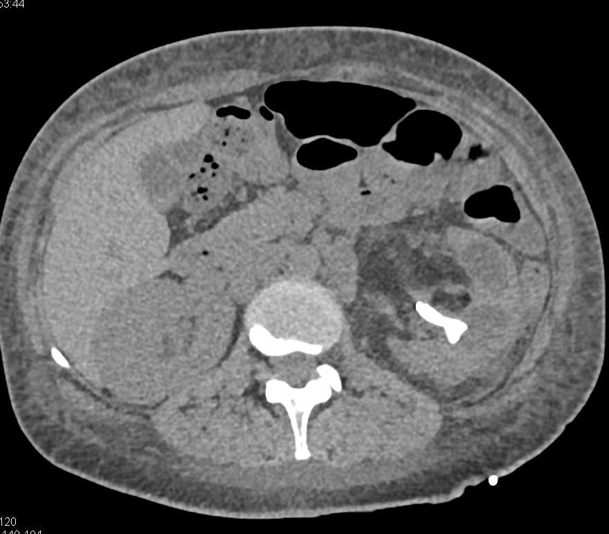 Large Bladder Stone Forms Around a Catheter that had been in Place for Years - CTisus CT Scan