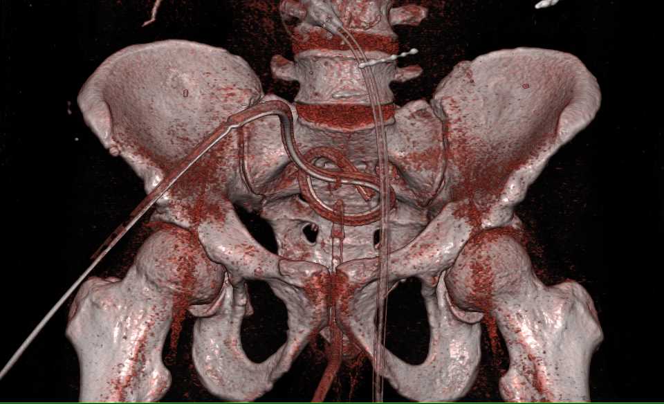 CT Cystogram Without Leak - CTisus CT Scan