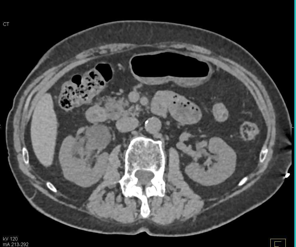 Transitional Cell Carcinoma Right Ureter - CTisus CT Scan