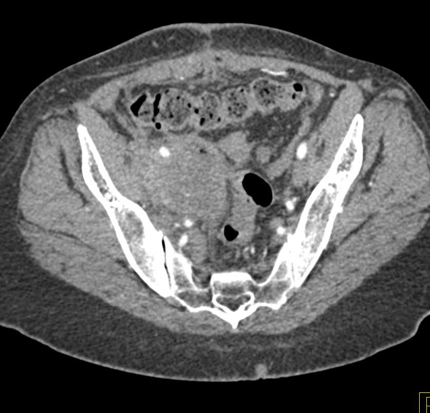 Large Necrotic Nodal Mass Obstructs Ureter - CTisus CT Scan